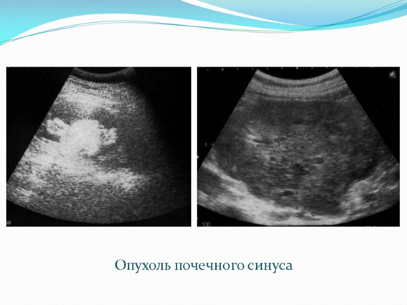 Опухоль почечного синуса